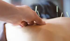 Person receiving dry needling on the back