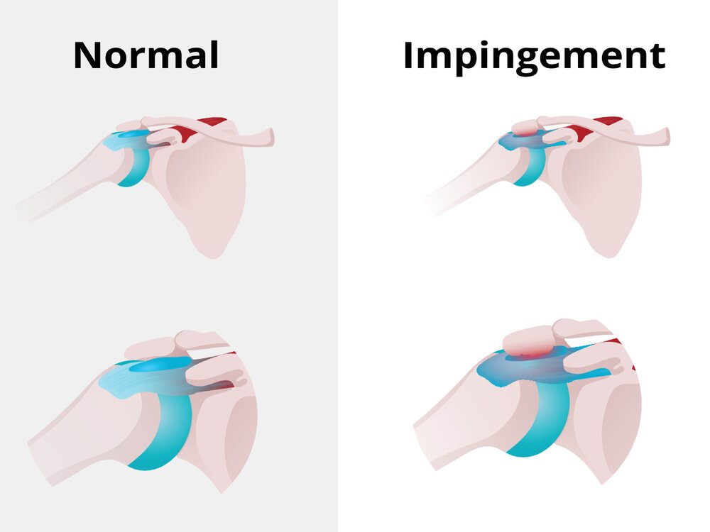 Shoulder Impingement Graphic